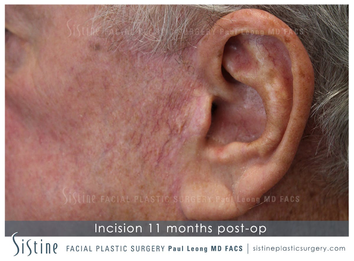 Facelift Before & After Gallery - Patient 407981 - Image 5