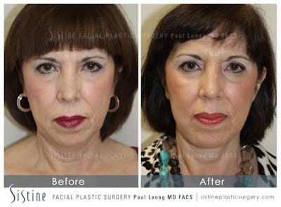 Eyes Before & After Gallery - Patient 163656 - Image 1