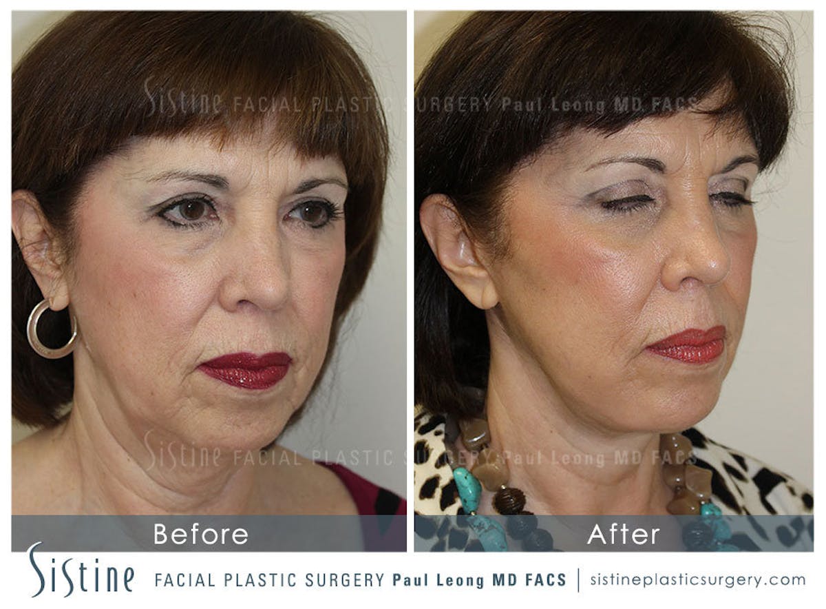Eyes Before & After Gallery - Patient 163656 - Image 2
