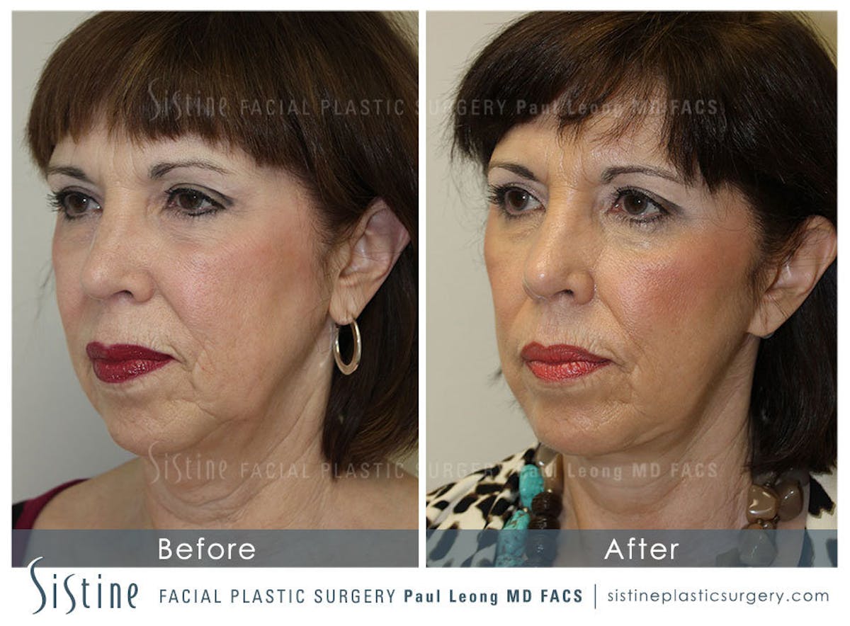 Eyes Before & After Gallery - Patient 163656 - Image 3