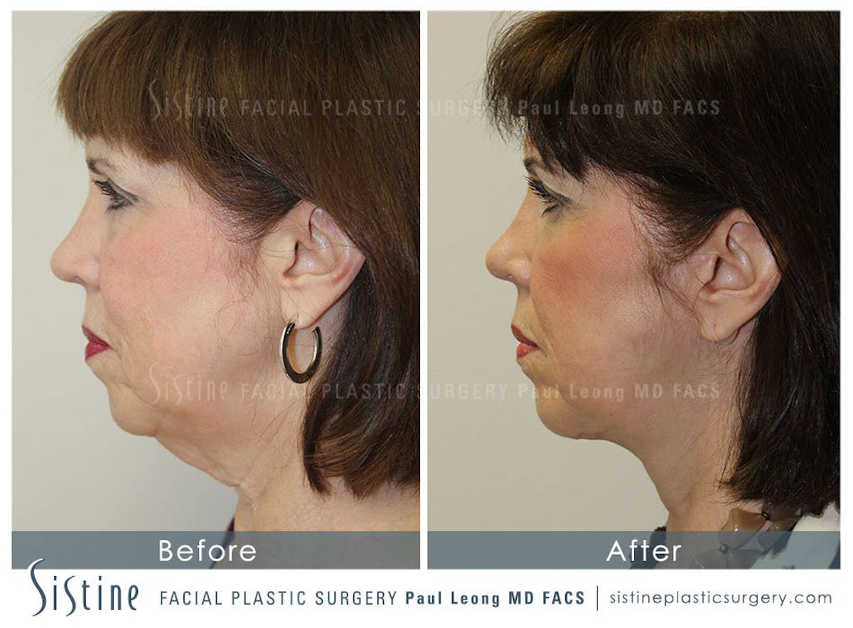 Eyes Before & After Gallery - Patient 163656 - Image 4