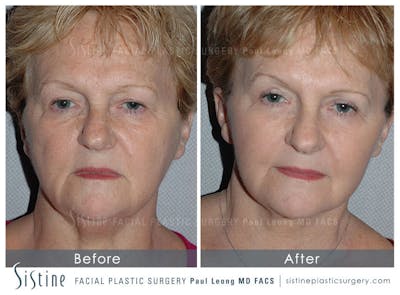 Eyes Before & After Gallery - Patient 211011 - Image 1