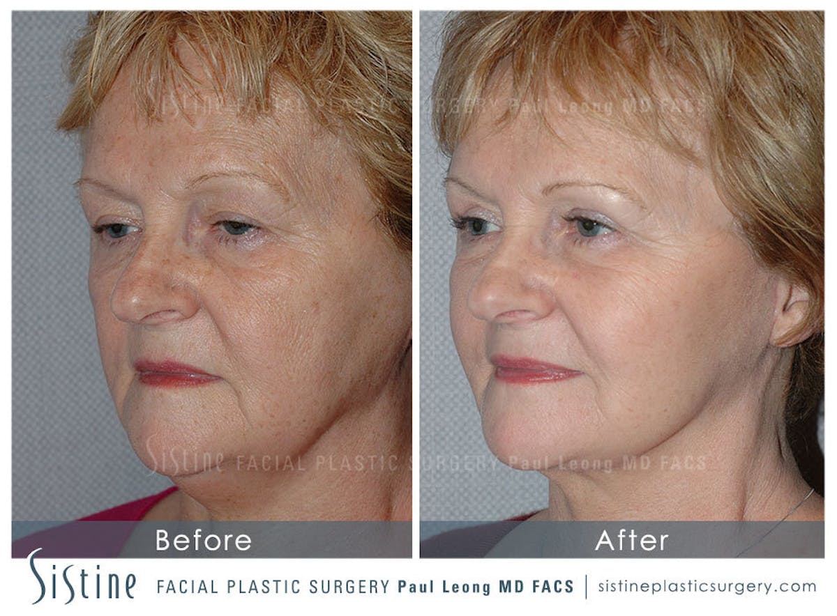 Eyes Before & After Gallery - Patient 211011 - Image 3