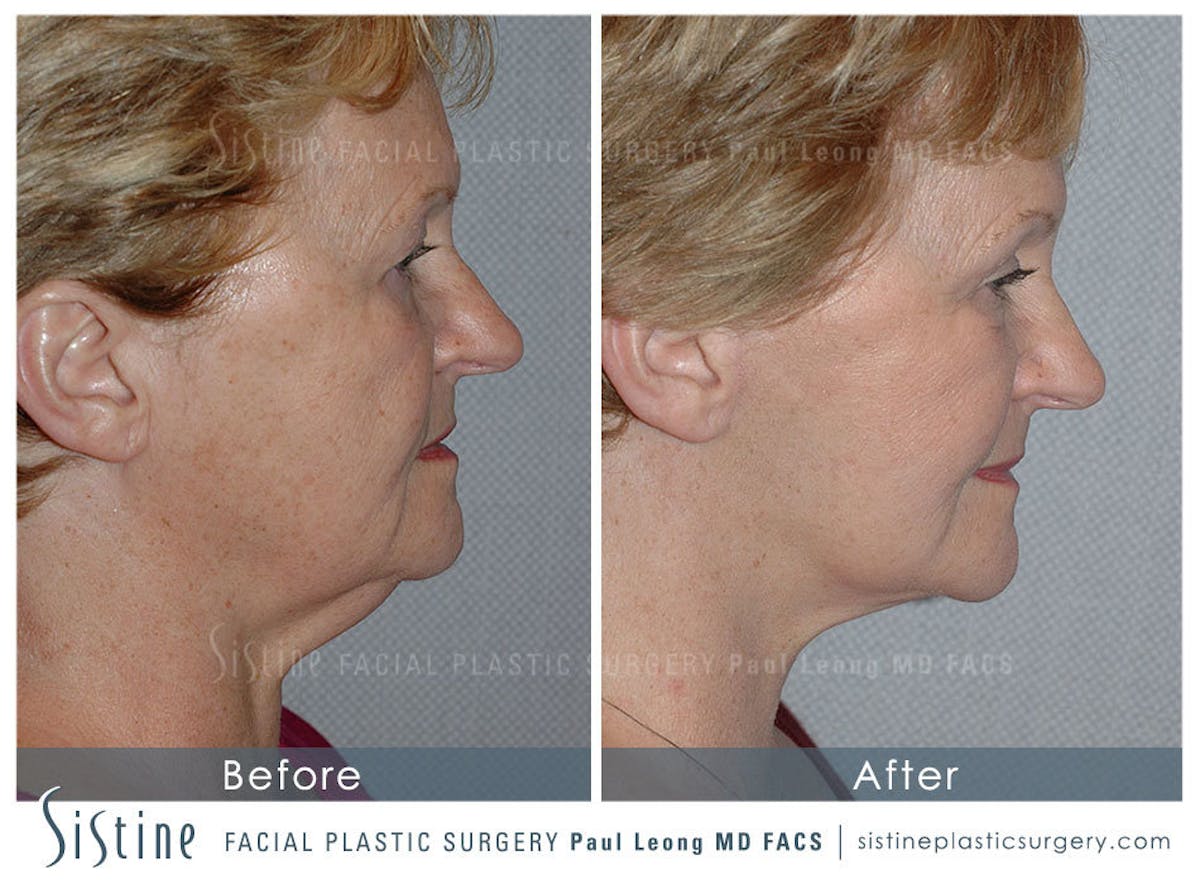 Eyes Before & After Gallery - Patient 211011 - Image 4