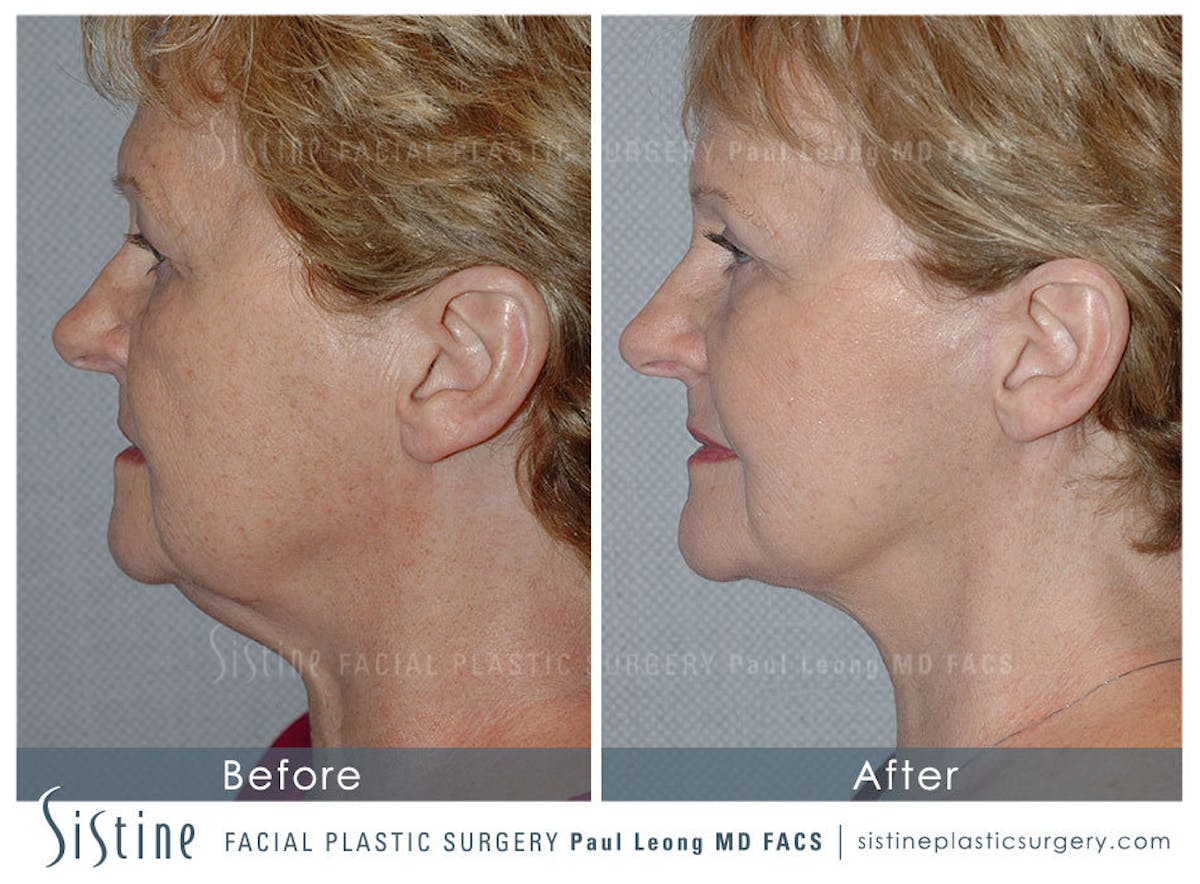 Eyes Before & After Gallery - Patient 211011 - Image 5