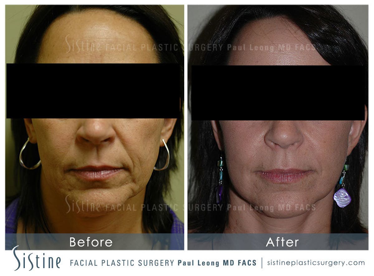 Ears Before & After Gallery - Patient 122487 - Image 1
