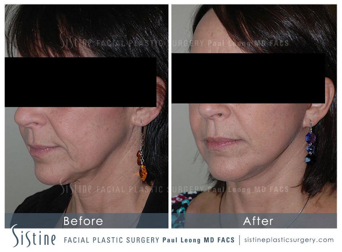Ears Before & After Gallery - Patient 122487 - Image 2