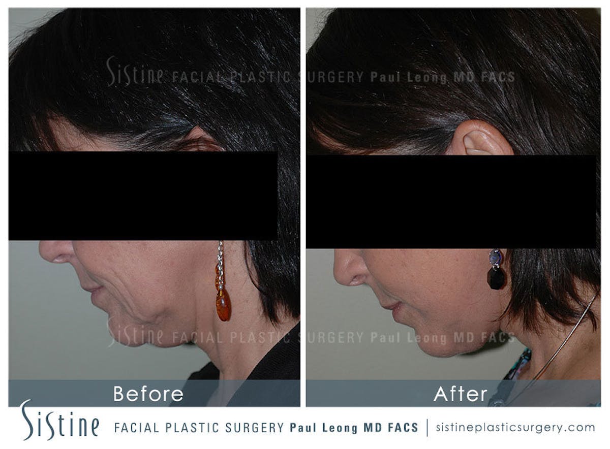 Ears Before & After Gallery - Patient 122487 - Image 4