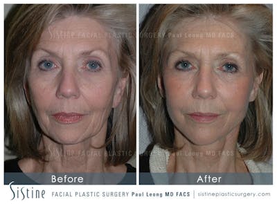 Fat Transfer Injections Before & After Gallery - Patient 158639 - Image 1