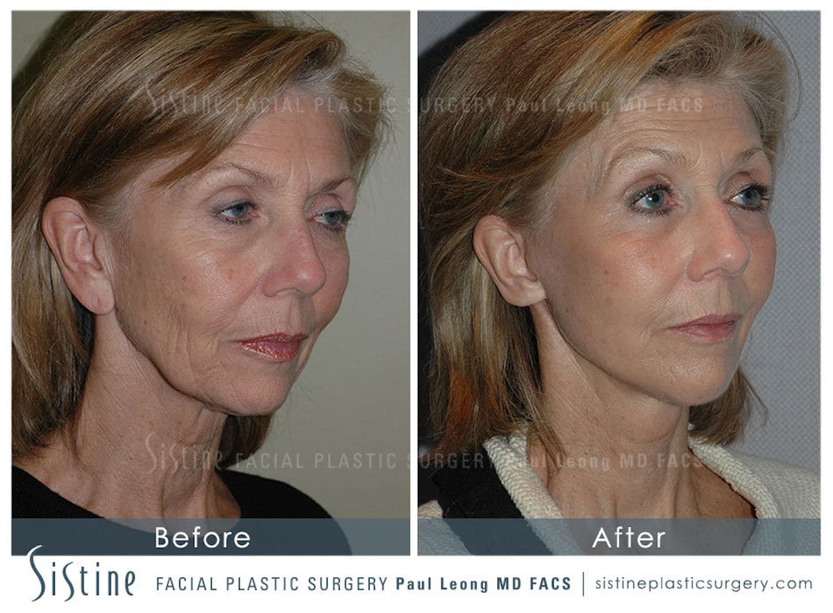 Eyes Before & After Gallery - Patient 239605 - Image 2
