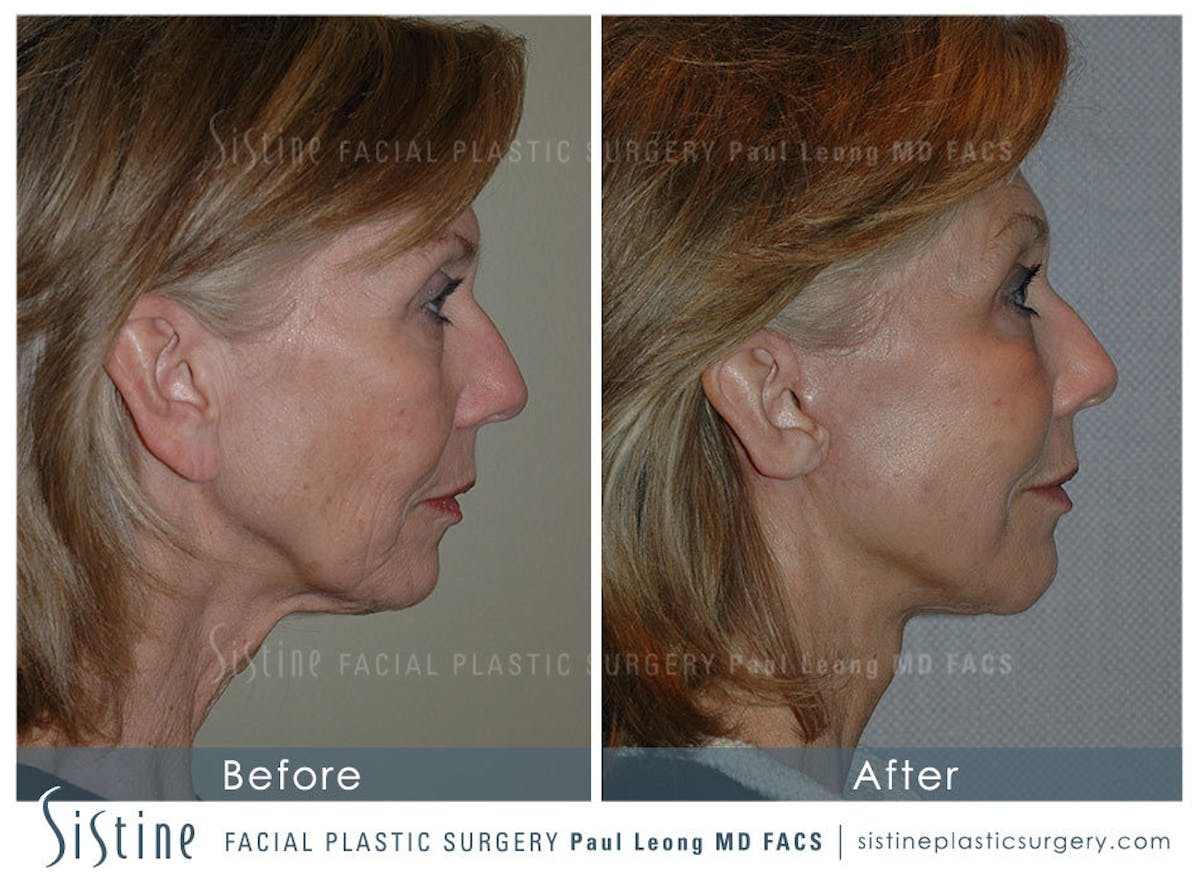 Eyes Before & After Gallery - Patient 239605 - Image 4