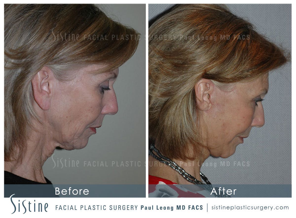 Eyes Before & After Gallery - Patient 239605 - Image 5