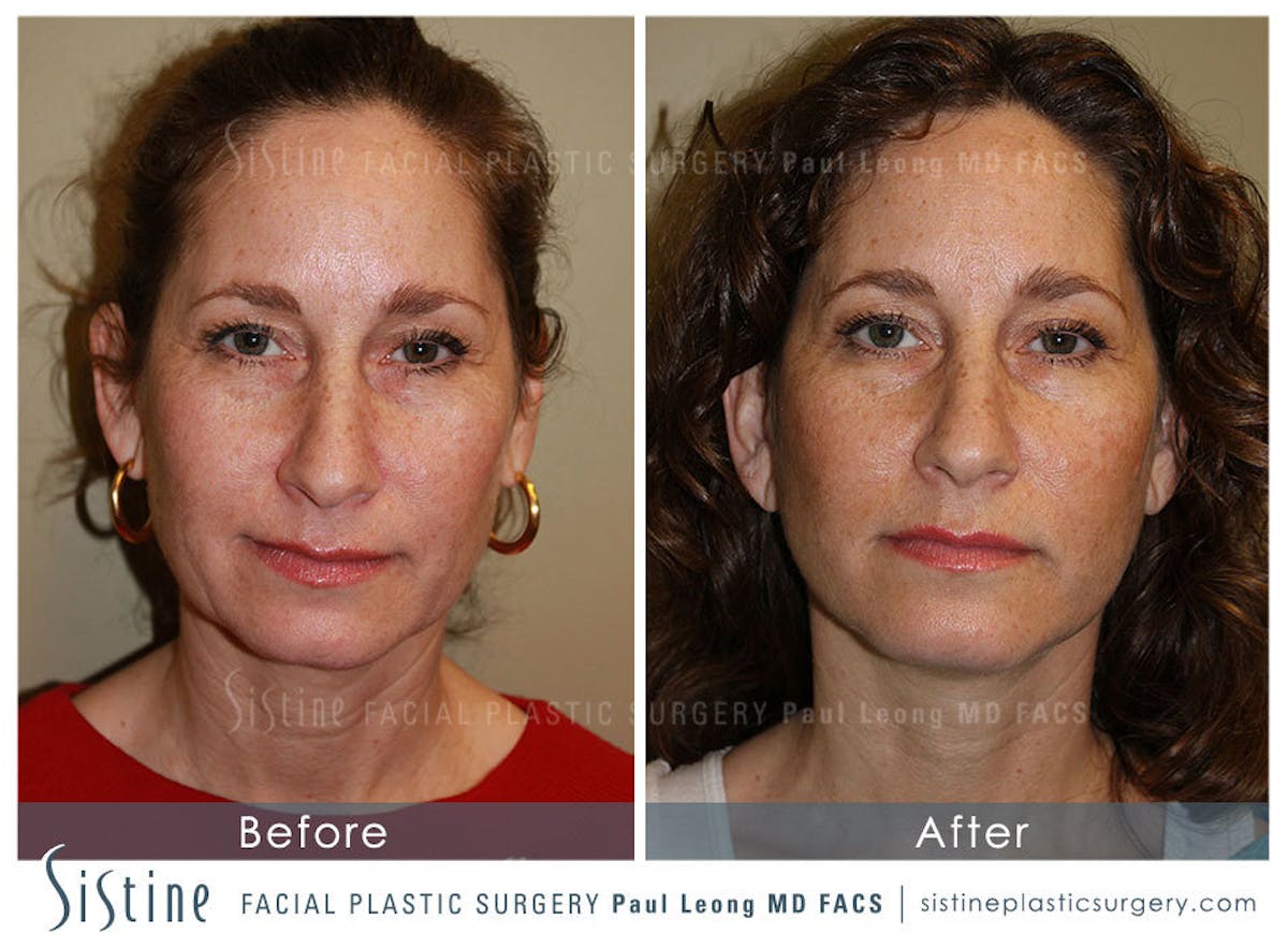 Facelift Before & After Gallery - Patient 371028 - Image 1