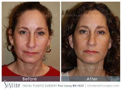 Facelift Before & After Gallery - Patient 371028 - Image 1