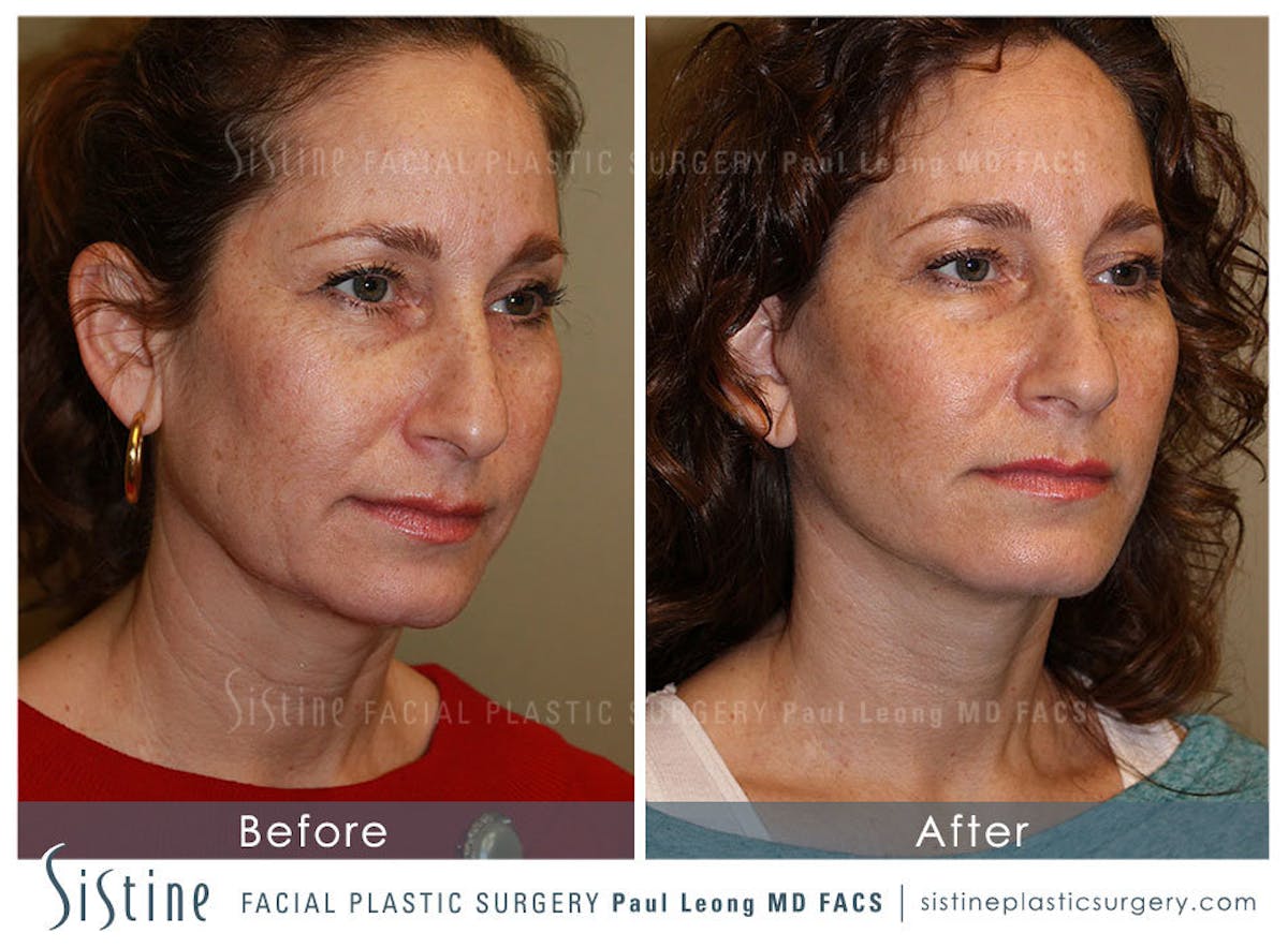 Facelift Before & After Gallery - Patient 371028 - Image 2