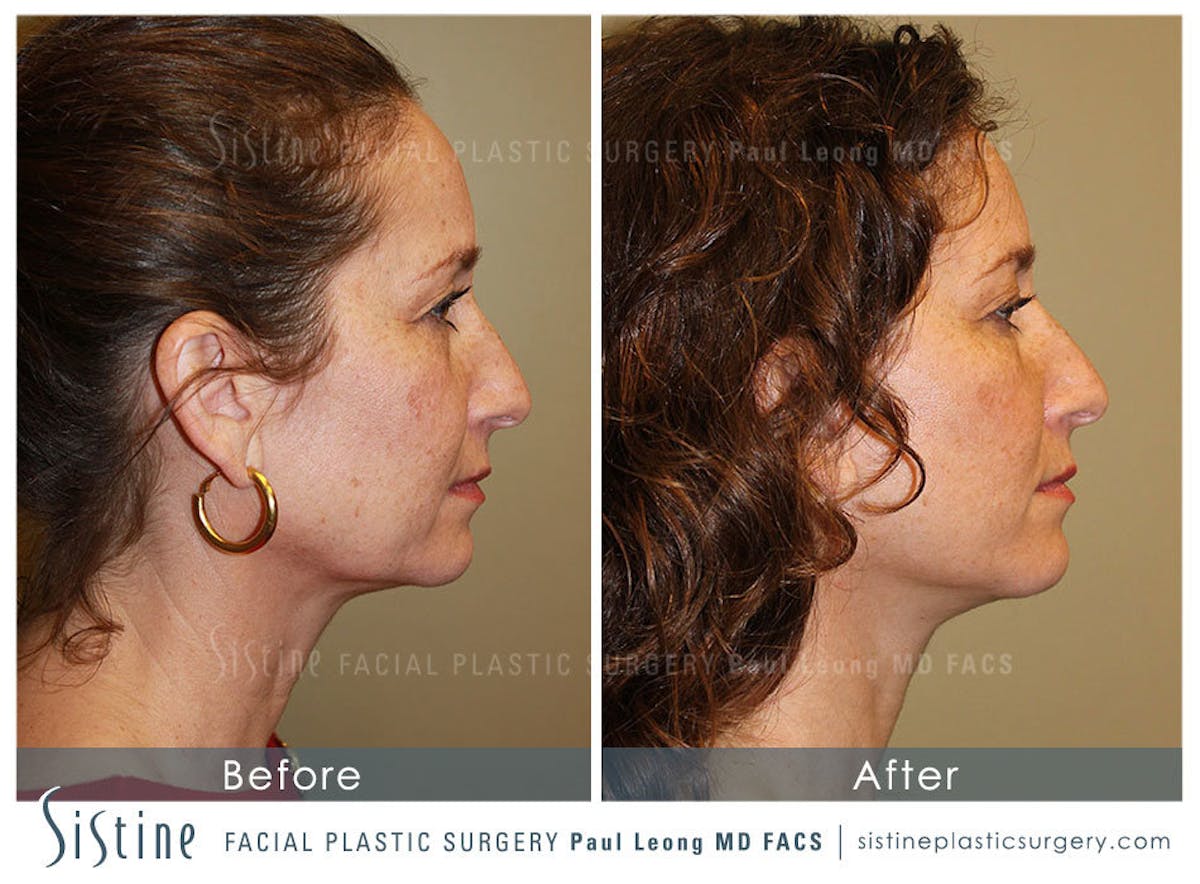 Facelift Before & After Gallery - Patient 371028 - Image 4