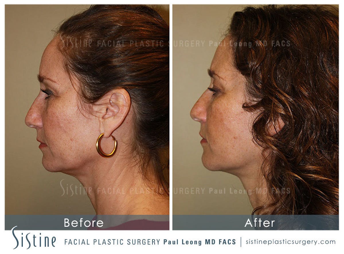 Facelift Before & After Gallery - Patient 371028 - Image 5