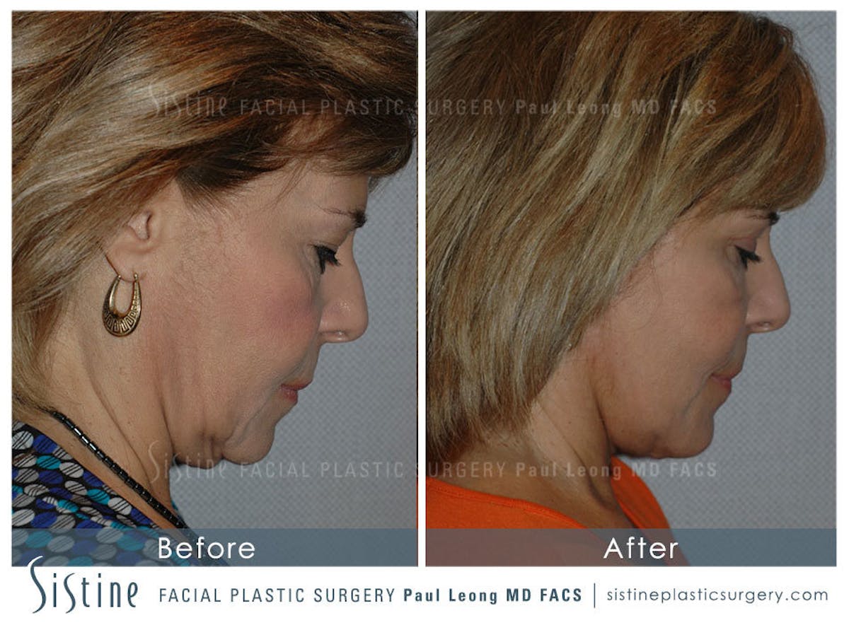 Eyes Before & After Gallery - Patient 105306 - Image 5