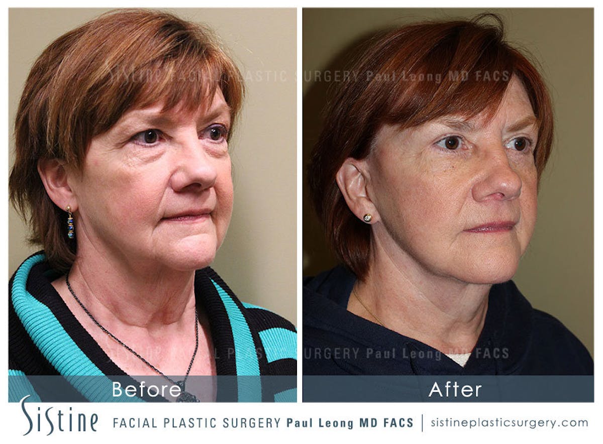 Eyes Before & After Gallery - Patient 266162 - Image 2