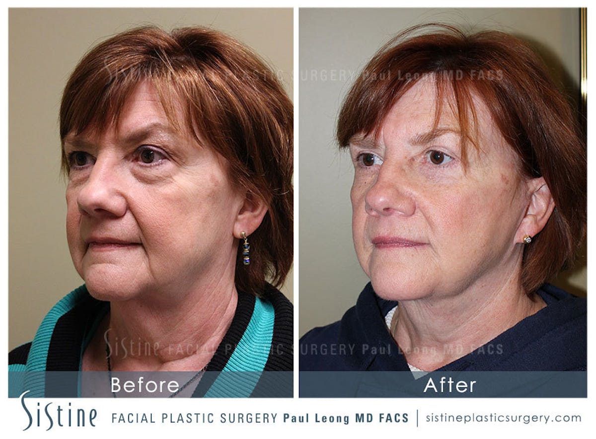 Eyes Before & After Gallery - Patient 266162 - Image 3