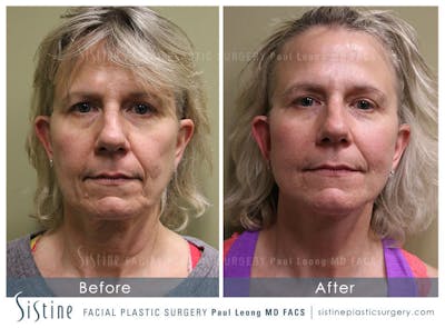 Facelift Before & After Gallery - Patient 200676 - Image 1