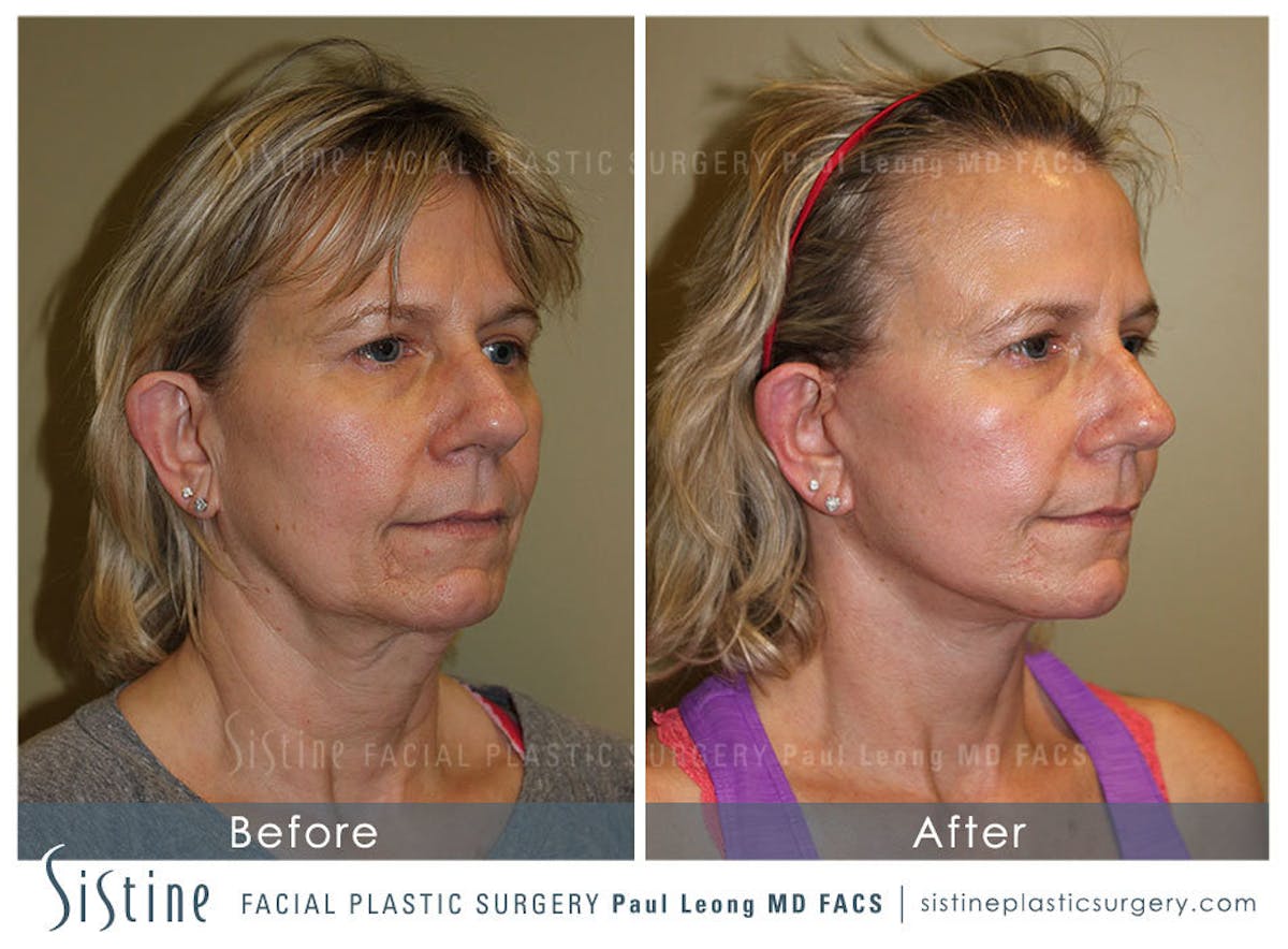 Facelift Before & After Gallery - Patient 200676 - Image 2