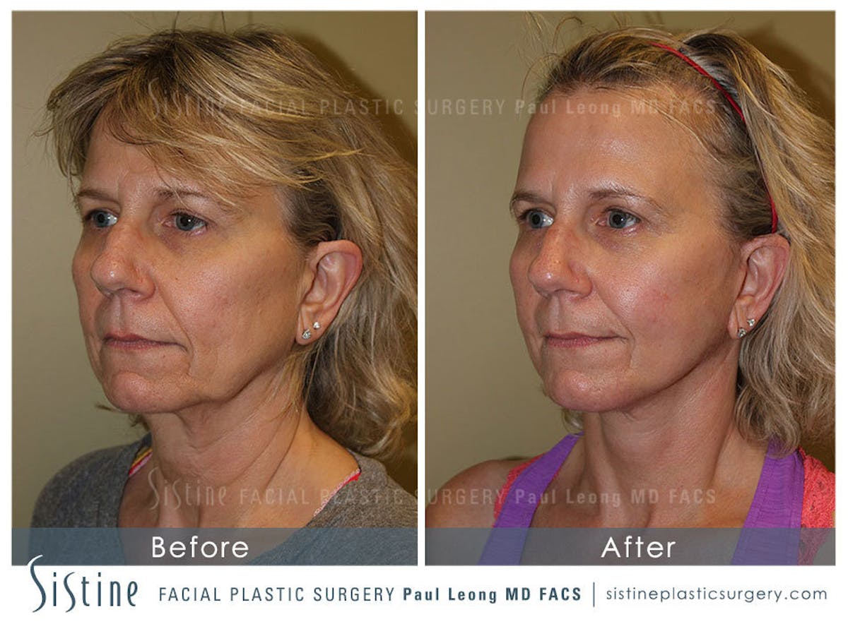 Facelift Before & After Gallery - Patient 200676 - Image 3