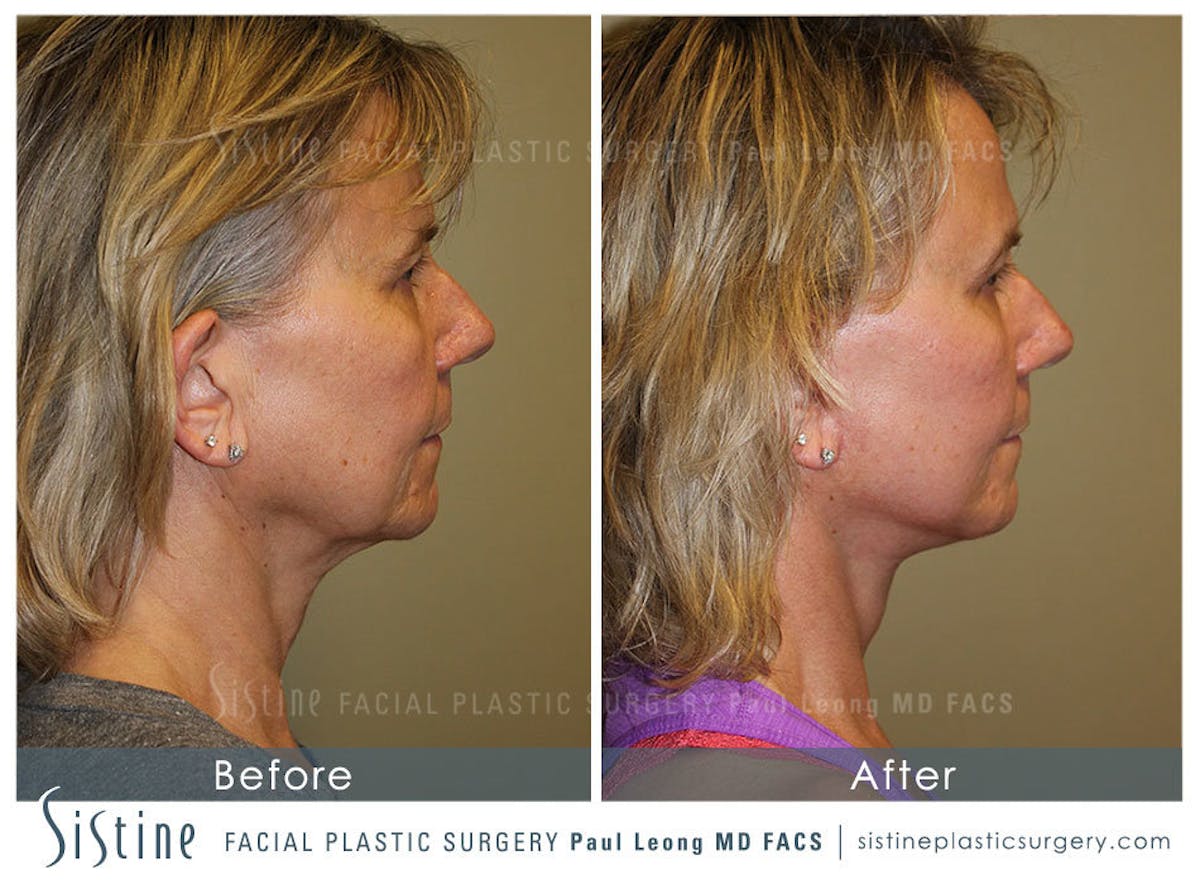 Facelift Before & After Gallery - Patient 200676 - Image 4