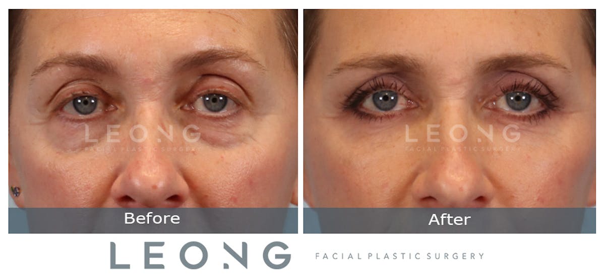 Blepharoplasty Before & After Gallery - Patient 387699 - Image 1