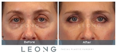 Blepharoplasty Before & After Gallery - Patient 387699 - Image 1