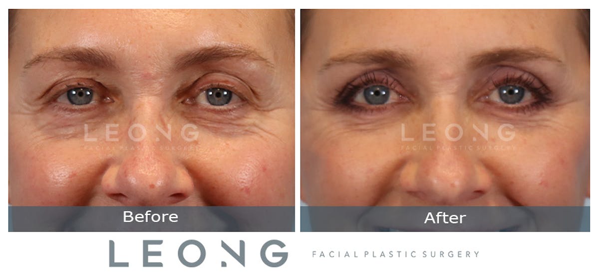 Blepharoplasty Before & After Gallery - Patient 387699 - Image 2