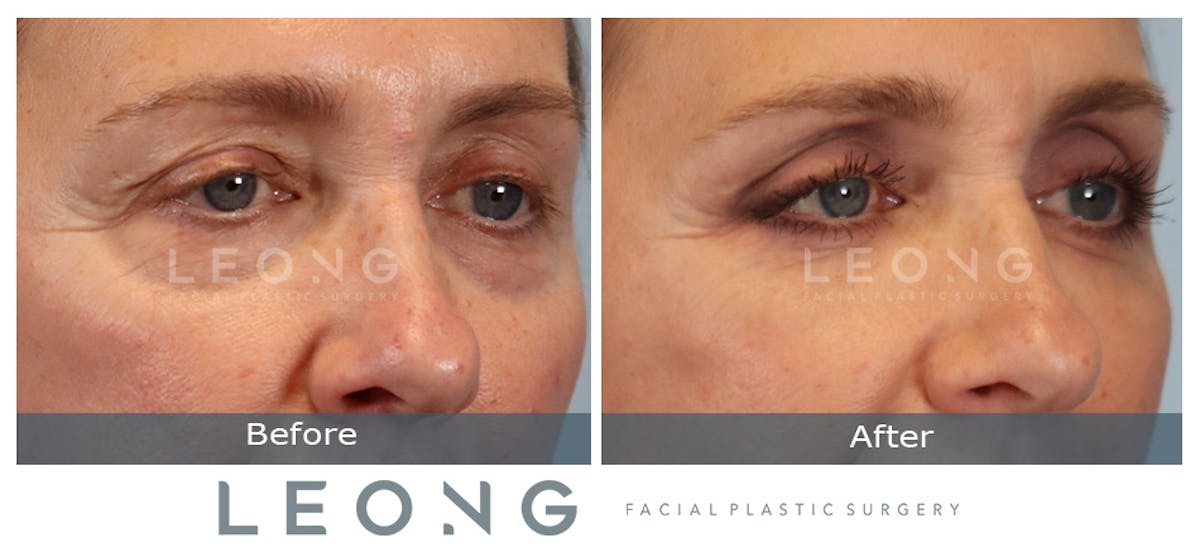 Blepharoplasty Before & After Gallery - Patient 387699 - Image 3