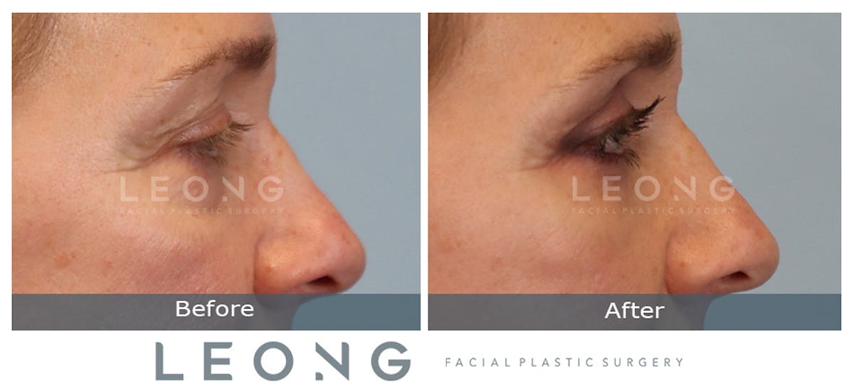Blepharoplasty Before & After Gallery - Patient 387699 - Image 4