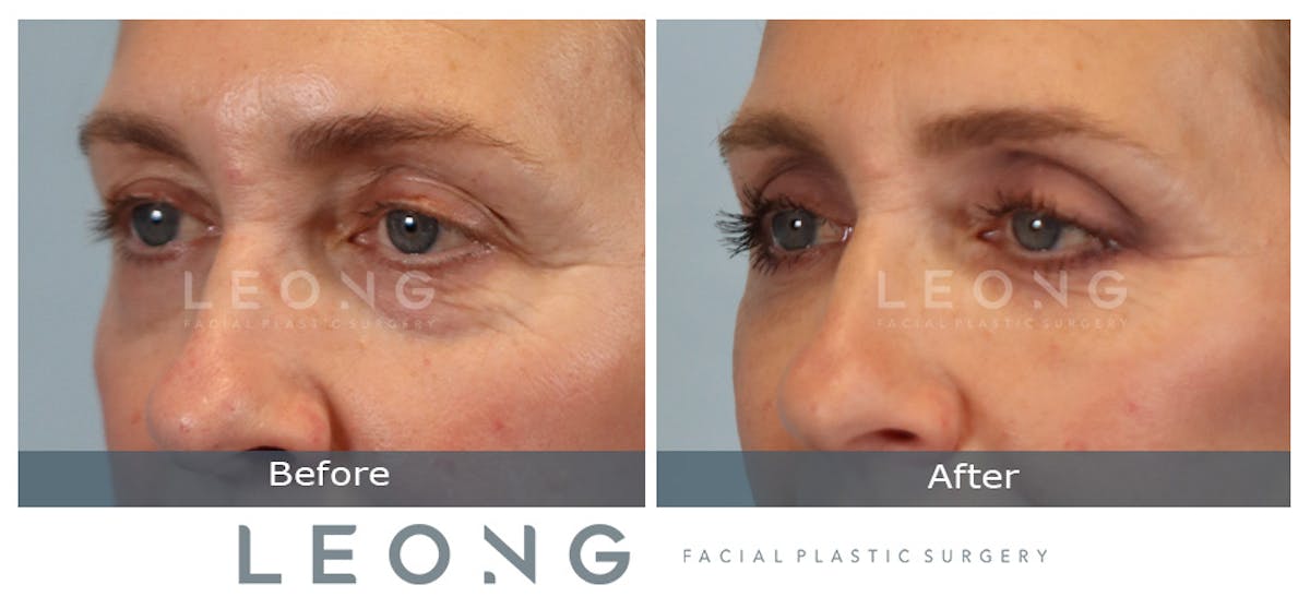 Blepharoplasty Before & After Gallery - Patient 387699 - Image 5