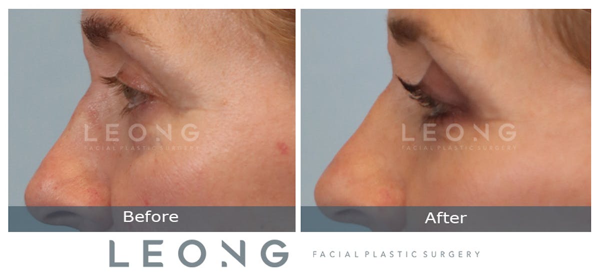 Blepharoplasty Before & After Gallery - Patient 387699 - Image 6