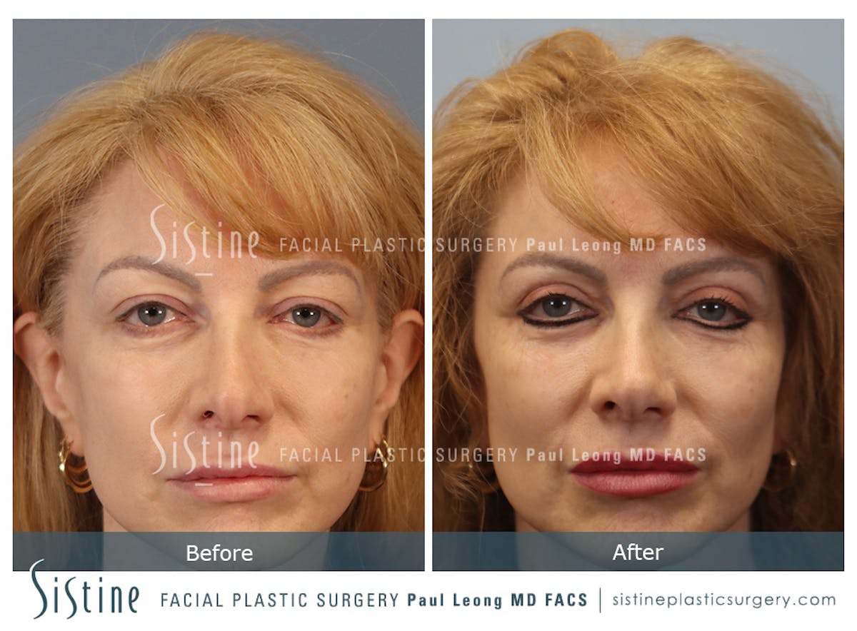 Blepharoplasty Before & After Gallery - Patient 964435 - Image 1