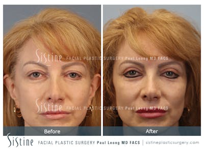 Blepharoplasty Before & After Gallery - Patient 964435 - Image 1
