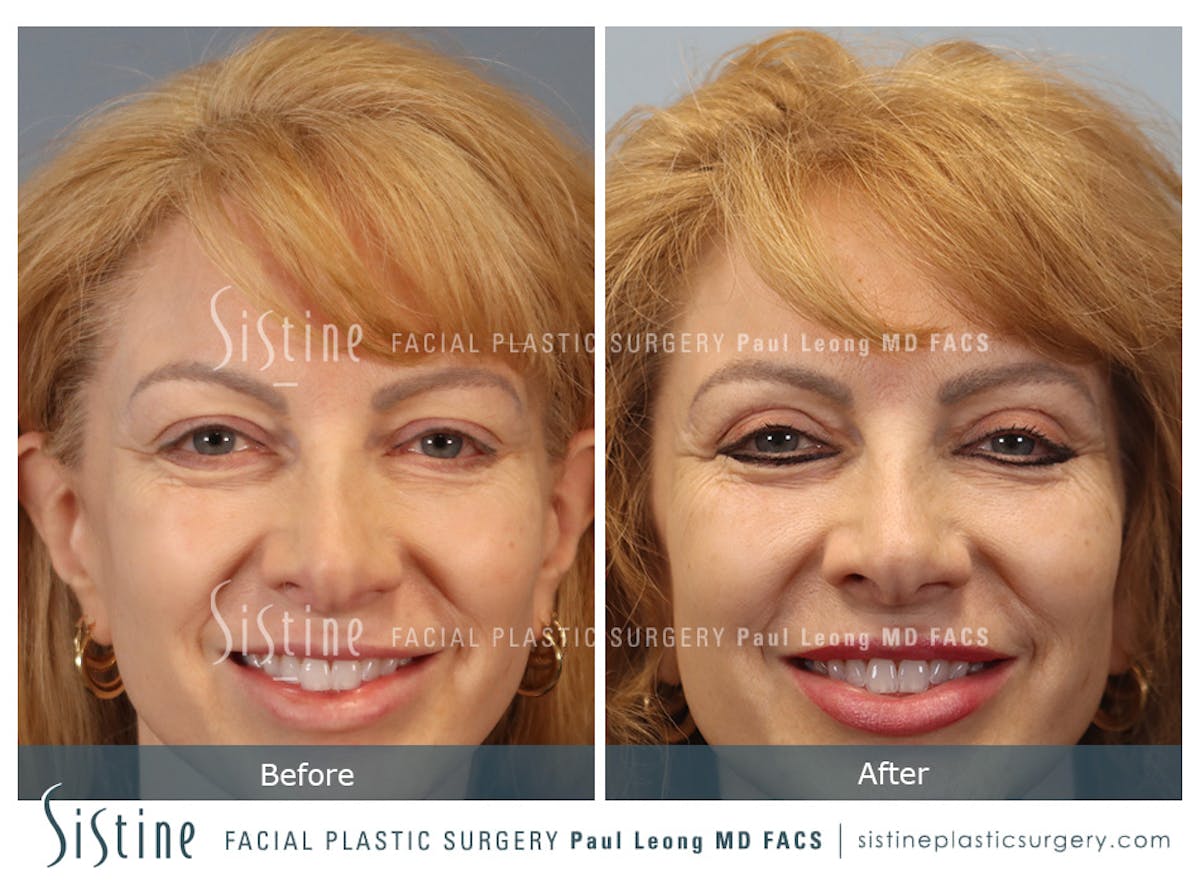 Blepharoplasty Before & After Gallery - Patient 964435 - Image 2
