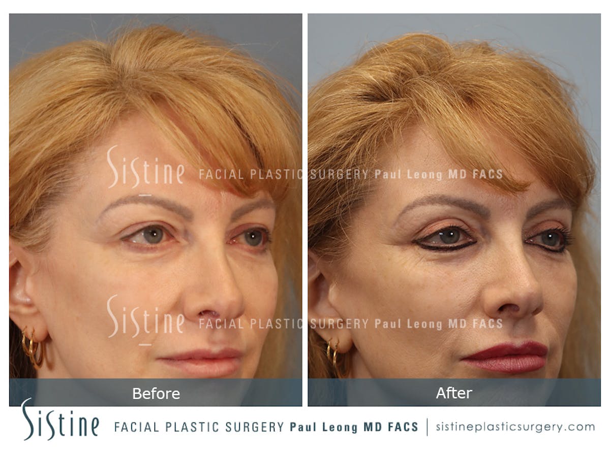 Blepharoplasty Before & After Gallery - Patient 964435 - Image 3