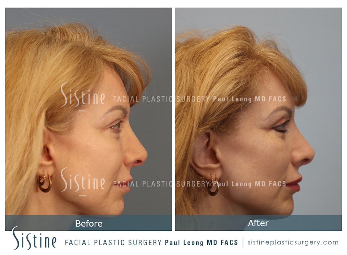Blepharoplasty Before & After Gallery - Patient 964435 - Image 4