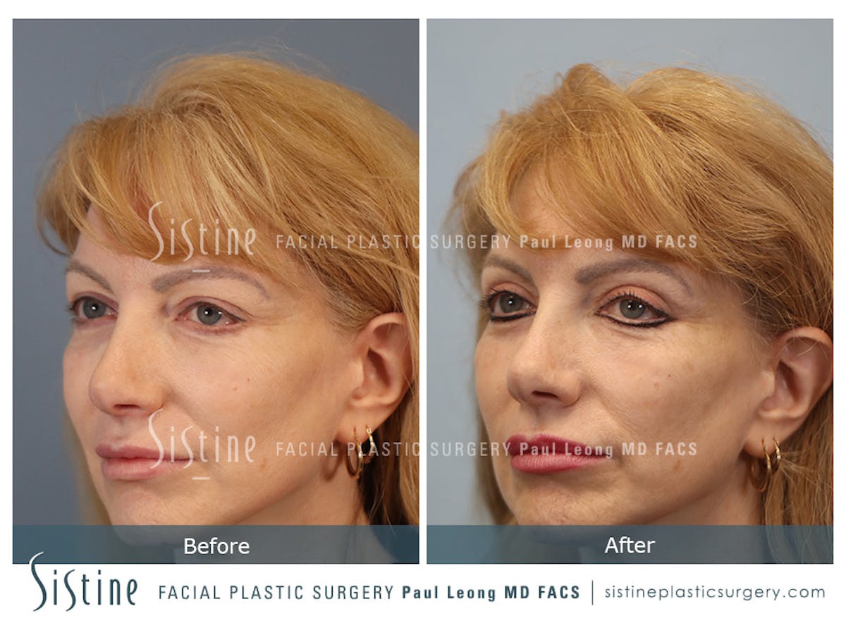 Blepharoplasty Before & After Gallery - Patient 964435 - Image 5