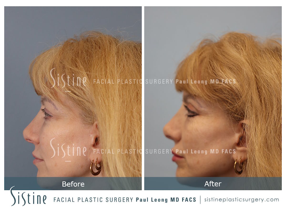 Blepharoplasty Before & After Gallery - Patient 964435 - Image 6