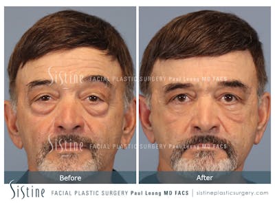 Blepharoplasty Before & After Gallery - Patient 203533 - Image 1