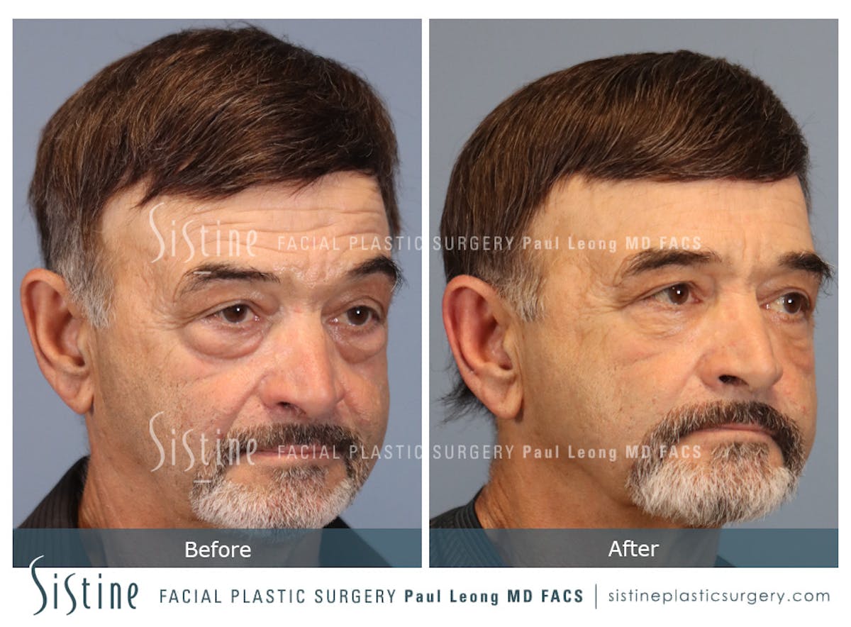 Blepharoplasty Before & After Gallery - Patient 203533 - Image 2