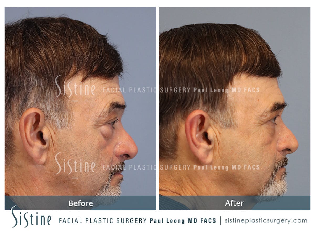 Blepharoplasty Before & After Gallery - Patient 203533 - Image 3
