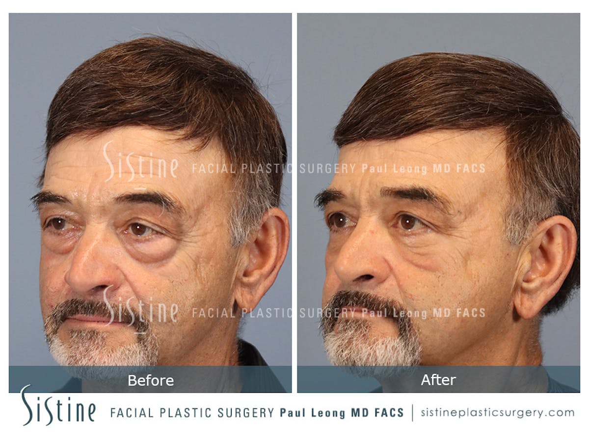 Blepharoplasty Before & After Gallery - Patient 203533 - Image 4