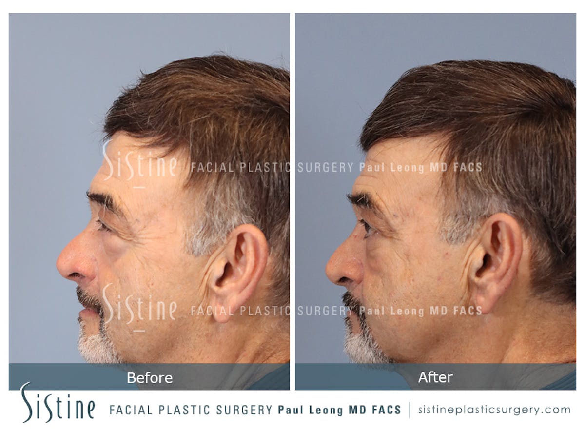 Blepharoplasty Before & After Gallery - Patient 203533 - Image 5