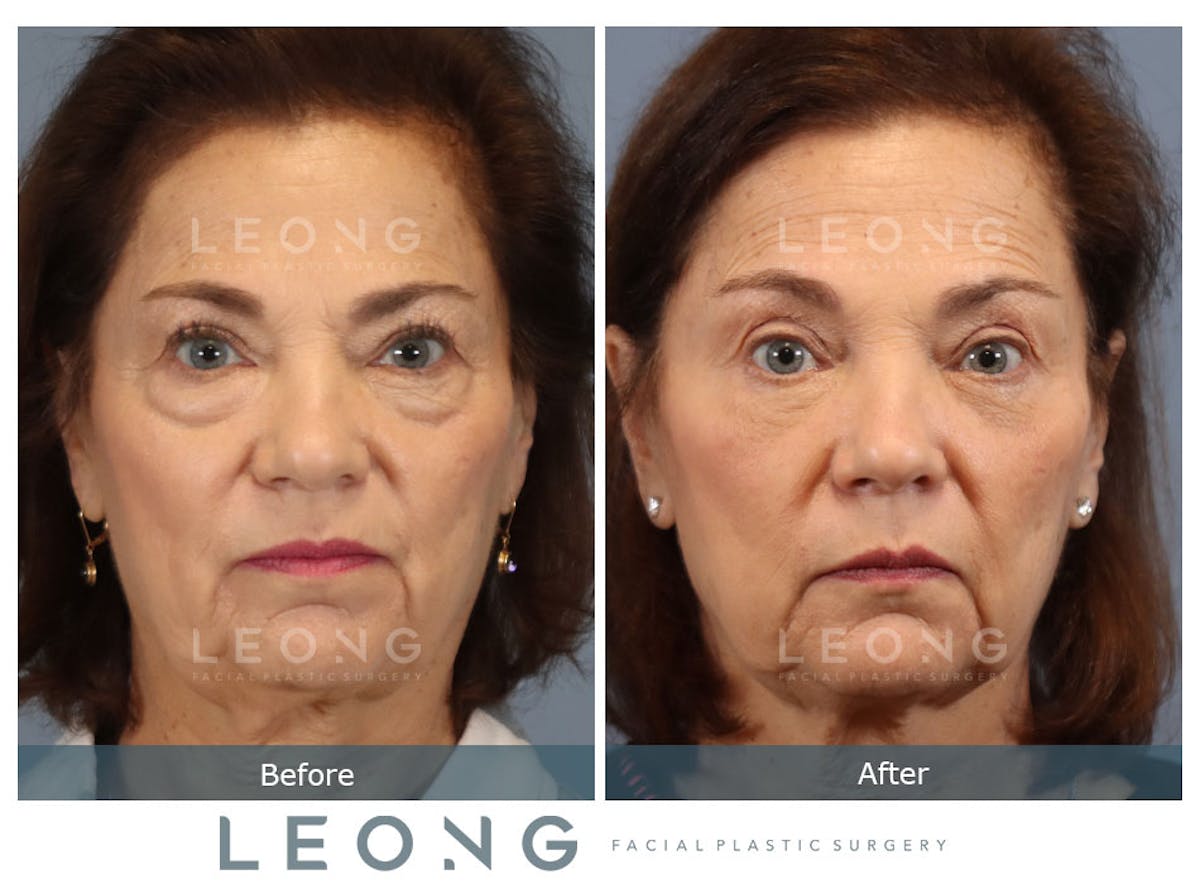 Blepharoplasty Before & After Gallery - Patient 770136 - Image 1