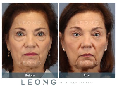 Blepharoplasty Before & After Gallery - Patient 770136 - Image 1