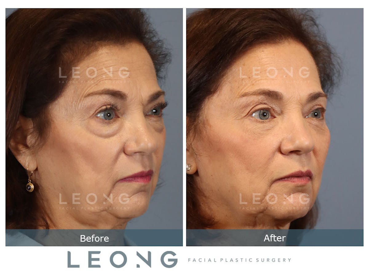 Blepharoplasty Before & After Gallery - Patient 770136 - Image 2